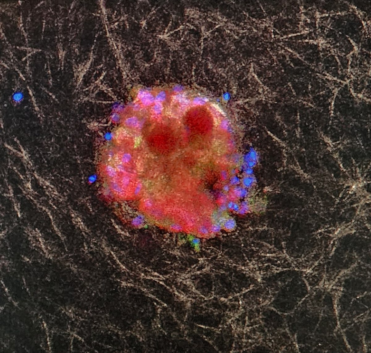 Confocal image of a tumor spheroid embedded in a 3D collagen matrix